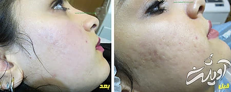 روش از بین بردن جای جوش از بین بردن قرمزی جای جوش صورت, از بین بردن جای جوش با لیزر, راه های از بین بردن جای جوش